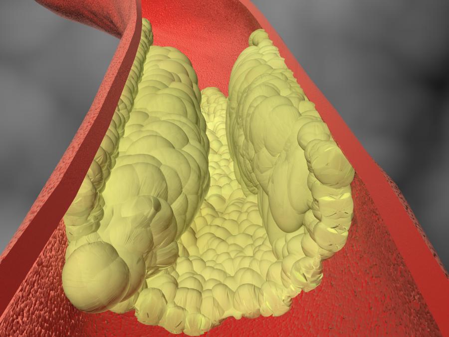 Testing for Calcium in the Coronary Arteries Provides Better Way to