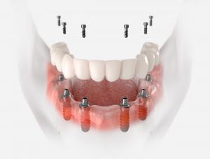 All-on-6 dental implant