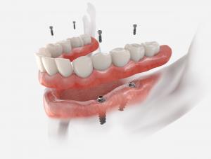 All-on-4 dental implant