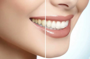 Wisdom Teeth Removal