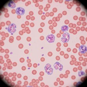 Thrombocytopenia Management Market Size
