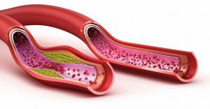 PAD is a buildup of fatty deposits in the arteries, which can slow normal blood flow to the heart and brain as well as the extremities.