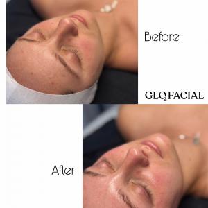 Glo2Facial before and after results Aurora Ohio