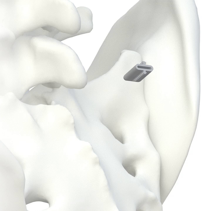 Image demonstrating the SiJoin T5 transfixing the sacroiliac joint at the superior articular surface