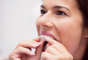 Beverly Hills Invisalign adult treatment