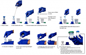 Crow's Nest Biopsy Catchment System in use, step by step