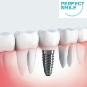all on 4 dental implants