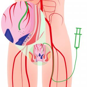 A diagram of how the HAE procedure works. A catheter is guided to the artery supplying the hemorrhoid and tiny microspheres are released to partially block the flow of blood to the hemorrhoid causing the hemorrhoid to shrink.