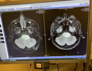 July 2019 MRI, Keeping an Eye on a DIPG