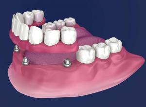Graphical representation of an All on 4 placement