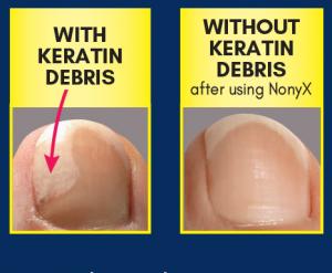 Large toe nail with keratin debris (Before) and second image (After) of toe nail after using NONY