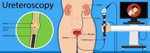 Ureteroscopy Market Research Report 2019-2025