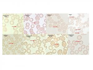 Representative light microscopy images of carbonaceous (black) particles adherent to red blood cells (red arrows) from healthy volunteers. Each image is from a different adult volunteer.
