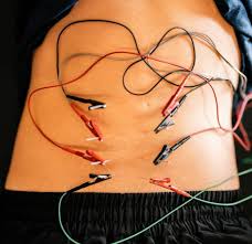 Dry needling lower back