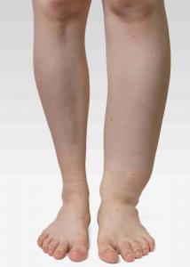 Lymphedema Treatment for Swollen Legs