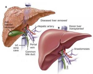 Liver Transplantation Market