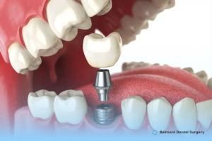 Dental Implants Perth