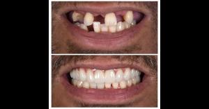 Patient results - Dental implants before and after