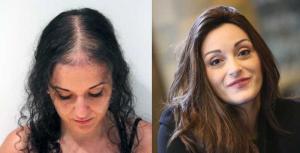 Women's non-surgical hair restoration before and after results at Fidenza Hair Co. San Diego
