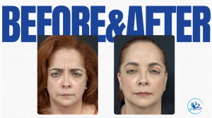 CMA - Before & After Botox