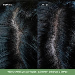 Before and after scalp comparison demonstrating reduced visible flakes after using Zion Health Ancient Clay Anti-Dandruff Shampoo.