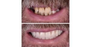 Dental Implant Patient Results