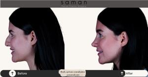 Long term ultrasonic rhinoplasty results by Masoud Saman in New York City