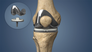 knee reconstruction devices market