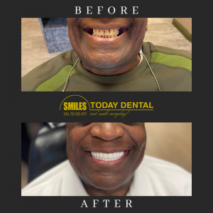 Before & After of a male patient with dental implants in Las Vegas, NV