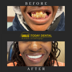 Before & After of a female patient with dental implants in Las Vegas, NV
