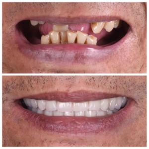 Patient Smile Transformation with Dental Implants Brisbane