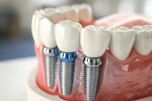Teeth Implants Perth