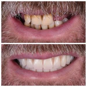 Dental Implant Treatment Pre and Post Procedure