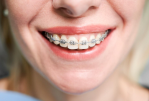 Dental Braces in Los Angeles