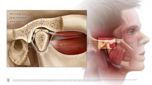 Illustration of the temporomandibular joint (TMJ)