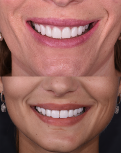 Getting Veneers in Mexico