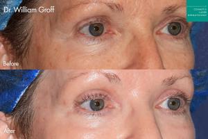 Female patient's eyes before and after Take10Eyes treatment in San Diego