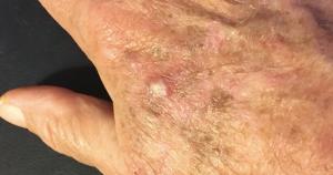 actinic keratosis treatment market