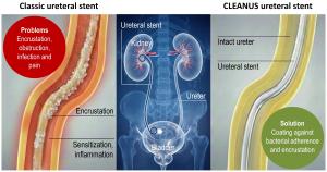 CLEANUS ureteral stent benefits