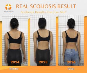 Results Driven Practice: Scoliosis Results You Can See