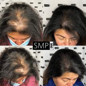 hair density treatment example with SMP INK for a female