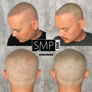 Example of SMP INK Hair line correction services