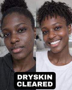 Before and after melanin rich skin transformation showing dry skin cleared using DreamSkin AI personalised skincare routine