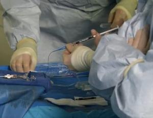 Image of the ULTRA Embolic Device being used by physicians in a case