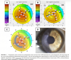 Images of a patients corneal topography pre and post the CAIRS procedure with the Brisbane Nomogram