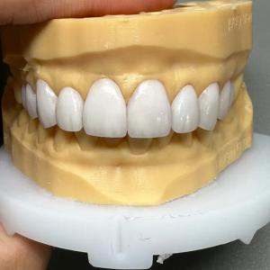 Sunflower Dental Lab - Ultra-Thin Veneers and E.max All-Ceramic
