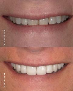 Before and After of Smile Trial