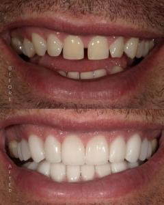 Before and After of Smile Trial - Male