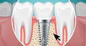 soft skeletal implants market