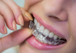 invisalign in beverly hills..